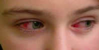 Conjunctivitis, Both Eyes - click for larger picture